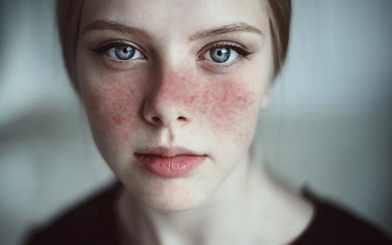 Lupus Ban Đỏ Là Bệnh Gì? Bệnh Lupus Ban Đỏ Có Nguy Hiểm Không?